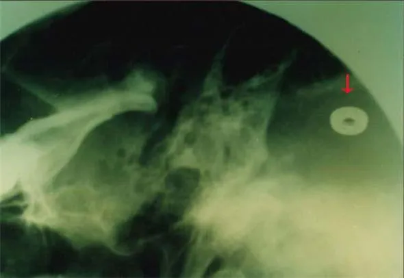 Имплантанты в голове и в руках. (фото и два видео)