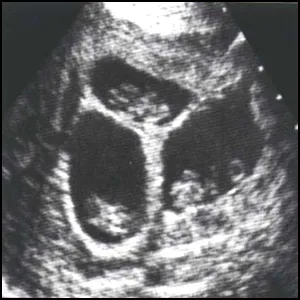 Стоит ли беременным делать УЗИ? Часть 2