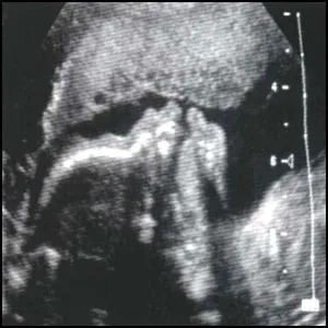 Стоит ли беременным делать УЗИ? Часть 3