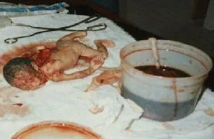 Людоедство в качестве «медицинской услуги»