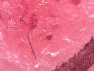 Болезнь моргеллонов