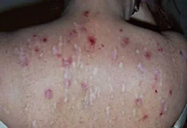 ГМО и заболевание Моргеллона ГМО и заболевание Моргеллона