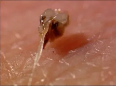 Discovery: Лечим укусами: пиявки, личинки и пчелы / Discovery: Leeches, Maggots And Bees: The Bite That Cures (2000) DVDRip