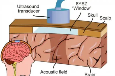 Киборгизация. В США впервые вживили в мозг человека влияющий на настроение имплант