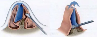 Септопластика: подготовка, этапы и восстановление